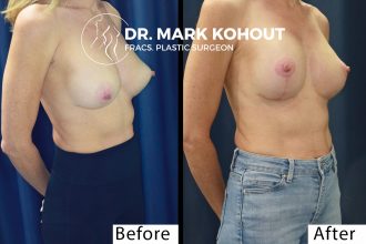 Breast-lift-with-existing-implants-by-Dr-Kohout 2069