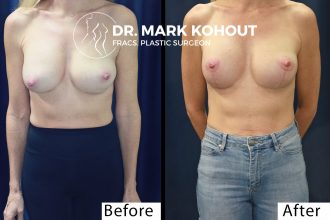 Breast-lift-with-existing-implants-by-Dr-Kohout 2069