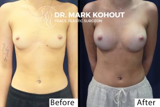 Breast Augmentation - 285cc Teardrop Implants Before and After Photo by. Dr.Kohout - 2071
