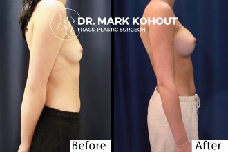 Breast Augmentation - 285cc Teardrop Implants Before and After Photo by. Dr.Kohout - 2071