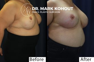 Breast-implant-exchange-and-Breast-revision-by-Dr-Kohout 2076