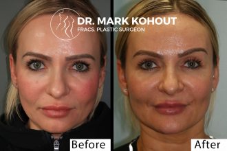 Browlift-and-upper-blepahroplasty-eyelid-reduction-by-Dr-Kohout 3035