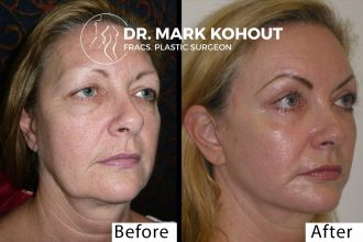 Facelift Cost Sydney | Blepharoplasty Medicare Cover