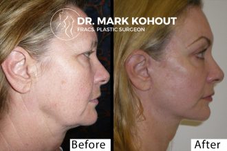 Facelift-blepahroplasty-and-laser-by-Dr-Kohout 3073