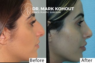 4019---Rhinoplasty-by-Dr-Kohout---side