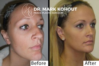 Chin-reduction-by Dr Kohout 4282