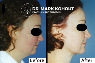 Chin-Liposuction-by Dr Kohout 4283
