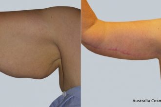 Arm-Reduction-2-14-from-Acc