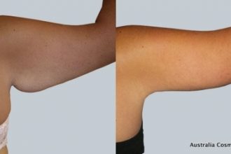 Arm-Reduction-3-12-From-Acc