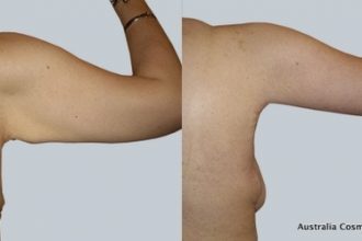 Arm-Reduction-4-9-From-Acc