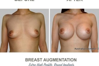 Breast-Augmentation-Round-Implants-round12-High-Profile-12-weeks-Post-Op-1