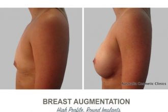Breast-Augmentation-Round-Implants-round2-High-Profile-12-weeks-Post-Op