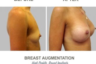 Breast-Augmentation-Round-Implants-round3-High-Profile-12-weeks-Post-Op-1