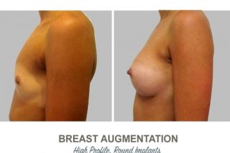 Breast-Augmentation-Round-Implants-round4-High-Profile-12-weeks-Post-Op
