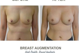 Breast-Augmentation-Round-Implants-round8-High-Profile-12-weeks-Post-Op 2
