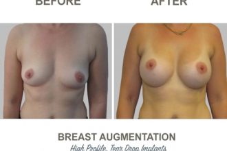 Breast-Augmentation-Tear-Drop-Implants-11-High-Profile-12-weeks-Post-Op