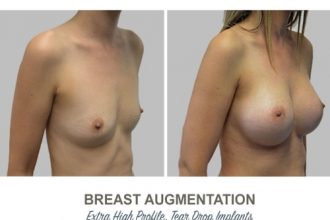 Breast-Augmentation-Tear-Drop-Implants-2-5-High-Profile-12-weeks-Post-Op