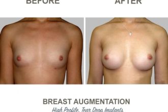 Breast-Augmentation-Tear-Drop-Implants-4-High-Profile-12-weeks-Post-Op