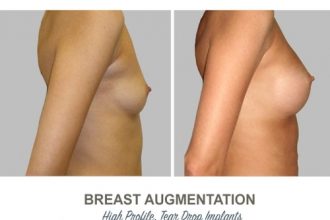 Breast-Augmentation-Tear-Drop-Implants-5-High-Profile-12-weeks-Post-Op