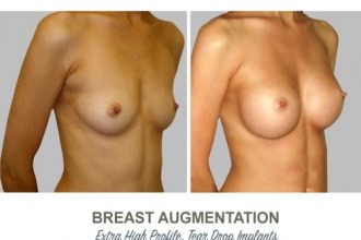 Breast-Augmentation-Tear-Drop-Implants-6-High-Profile-12-weeks-Post-Op