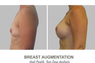 Breast-Augmentation-Tear-DropImplants-1-5-High-Profile-12-weeks-Post-Op