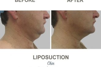 Chin-Liposuction-Dr-Mark-Kohout-2-8