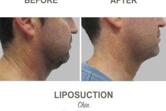 Chin-Liposuction-Dr-Mark-Kohout-3-6