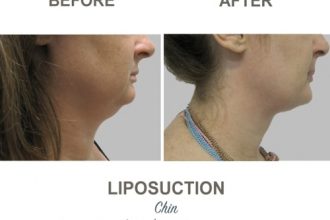 Chin-Liposuction-Dr-Mark-Kohout-4-3