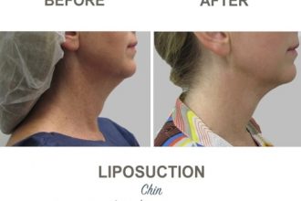 Chin-Liposuction-Dr-Mark-Kohout-5-2