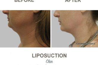 Chin-Liposuction-Dr-Mark-Kohout-6-2