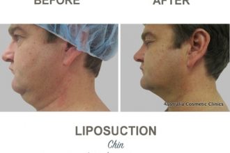 Chin-Liposuction-Dr-Mark-Kohout-7-2