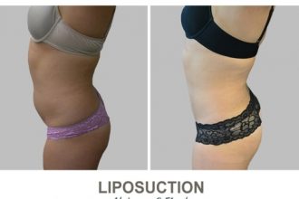 Liposuction-Before-and-After-Photos-10-1-Abdomen-and-Flanks