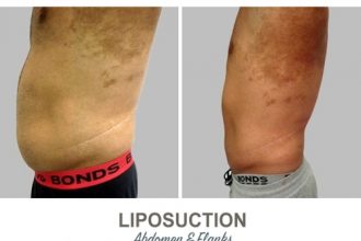 Liposuction-Before-and-After-Photos-11-1-Abdomen-and-Flanks