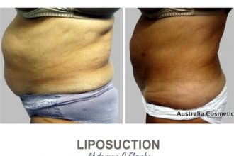 Liposuction-Before-and-After-Photos-13-Abdomen-and-Flanks