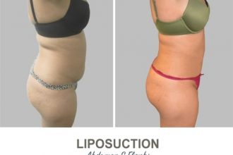 Liposuction-Before-and-After-Photos-14-Abdomen-and-Flanks
