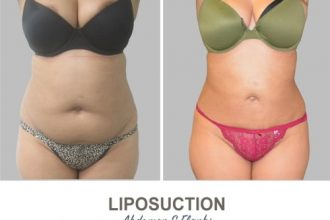 Liposuction-Before-and-After-Photos-15-Abdomen-and-Flanks