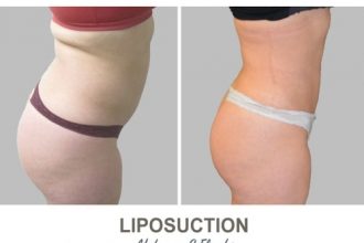 Liposuction-Before-and-After-Photos-16-Abdomen-and-Flanks