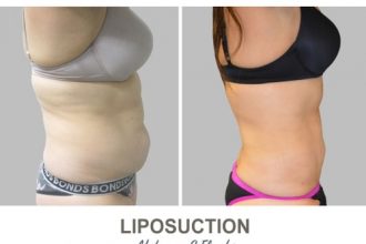 Liposuction-Before-and-After-Photos-17-Abdomen-and-Flanks