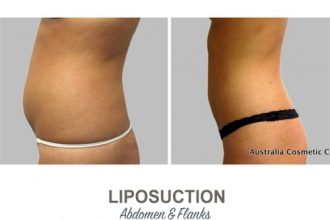 Liposuction-Before-and-After-Photos-18-Abdomen-and-Flanks