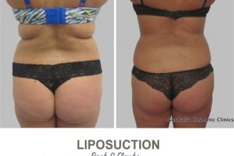 Liposuction-Before-and-After-Photos-19-Abdomen-and-Flanks