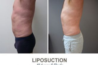 Liposuction-Before-and-After-Photos-2-6-Abdomen-and-Flanks