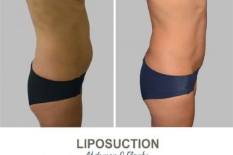 Liposuction-Before-and-After-Photos-20-Abdomen-and-Flanks