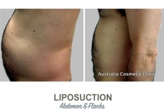 Liposuction-Before-and-After-Photos-21-Abdomen-and-Flanks