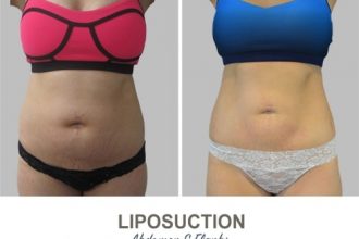 Liposuction-Before-and-After-Photos-22-Abdomen-and-Flanks