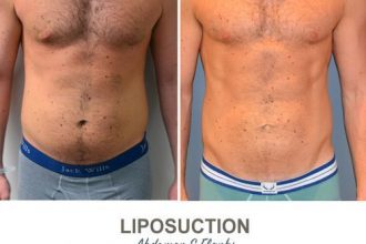 Liposuction-Before-and-After-Photos-3-4-Abdomen-and-Flanks