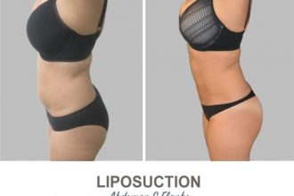 Liposuction-Before-and-After-Photos-5-1-Abdomen-and-Flanks