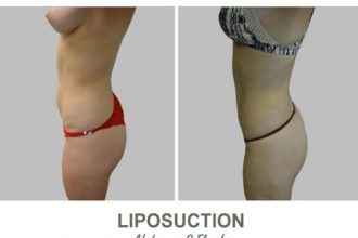 Liposuction-Before-and-After-Photos-6-1-Abdomen-and-Flanks