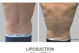 Liposuction-Before-and-After-Photos-8-1-Abdomen-and-Flanks