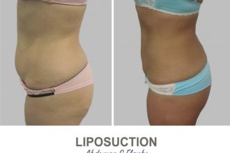 Liposuction-Before-and-After-Photos-9-1-Abdomen-and-Flanks