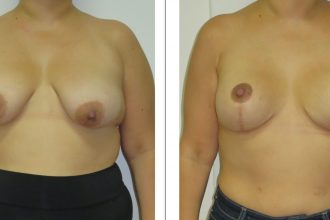 Mastopexy-03-scaled